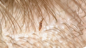 Can Fleas Live in Human Hair