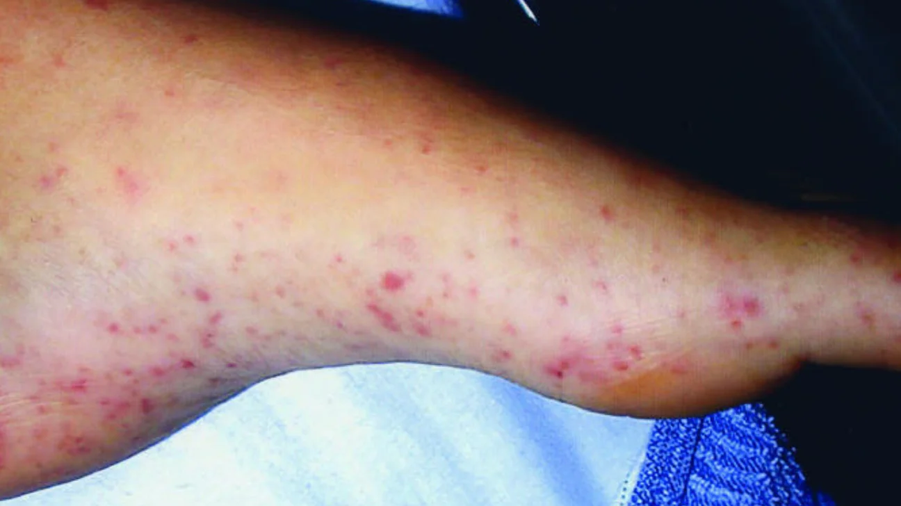 Mouse Bite Marks, Symptoms, Identification and More