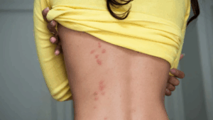 Bed Bug Bites Triangle